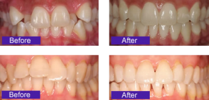 invisalign-before-after