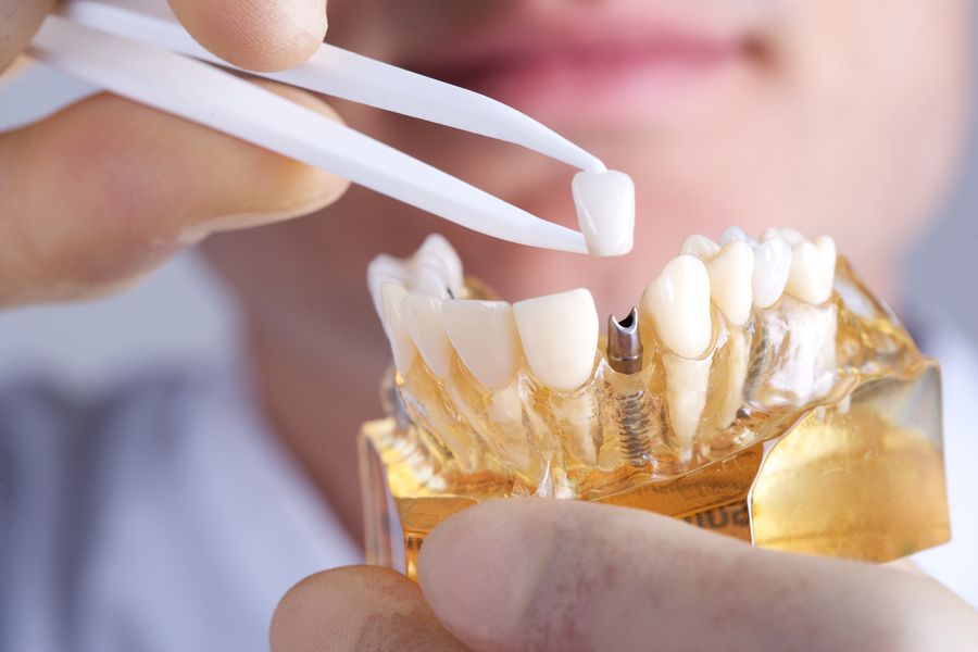 implant dentar Cluj, implantologie estetica dentara